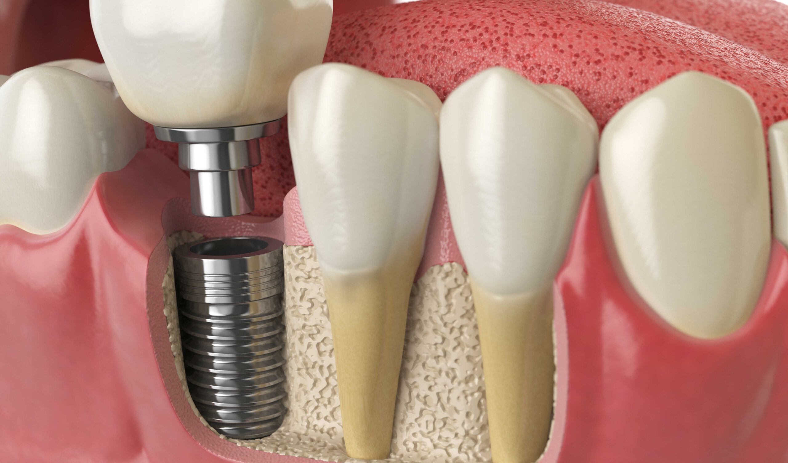 The Transformative Power of Dental Implants in Rochdale