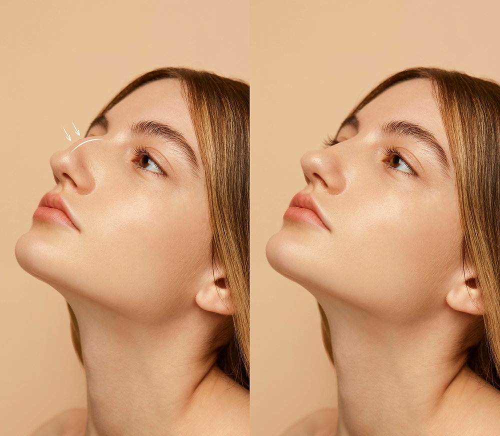 Enhancing Your Confidence: The Ultimate Guide to Nose Job in London